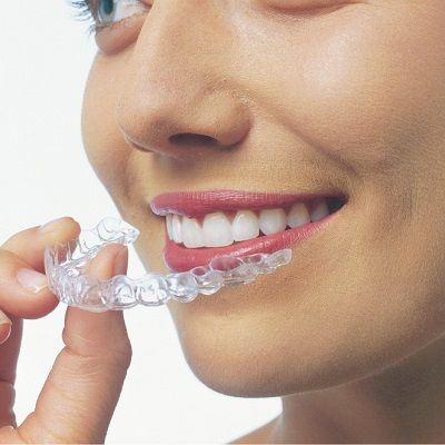 Teeth Aligners: How Teeth Aligners Work