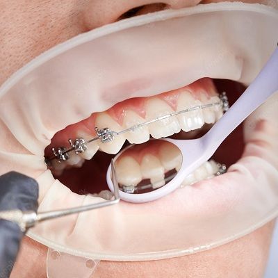 Teeth whitening with Dental Braces