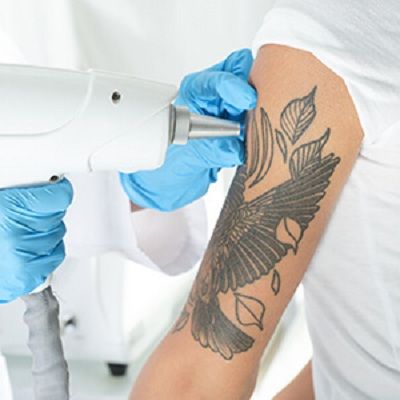 Can Laser Tattoo Removal Cause Skin cancer?