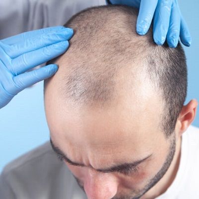 A Review of Modern Surgical Hair Restoration Techniques