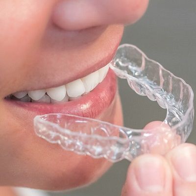 Are Aligners Good for Your Teeth