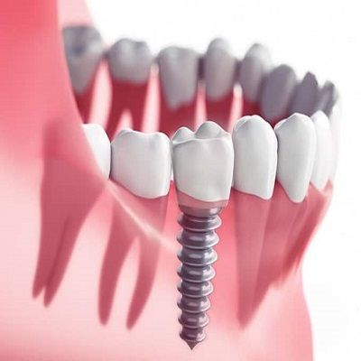 How Much Does it Cost to Replace all Teeth with Dental Implants
