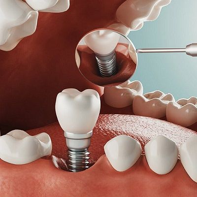 Is There a Cheaper Alternative to Dental Implants