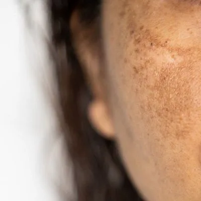 Melasma Treatment Cost in Dubai