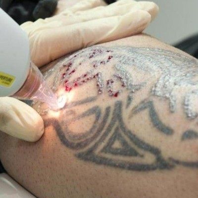 Tattoo Removal Near Me