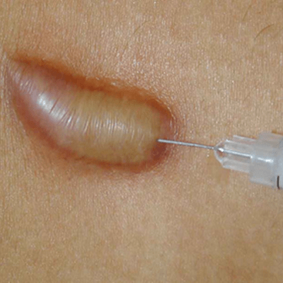 Keloid Scar Injection in Dubai