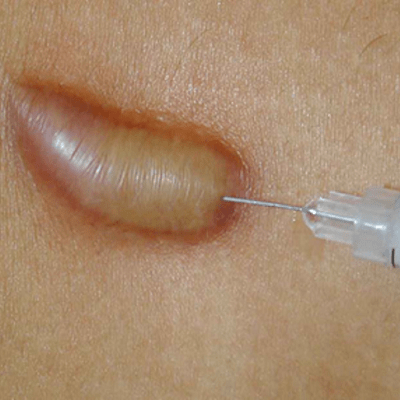 Keloid Scar Injection