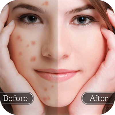 Can Pimples be Removed Permanently