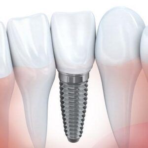 Dental Implants with Gum Diseases