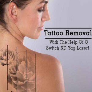 Saline Tattoo Removal vs Laser Tattoo Removal