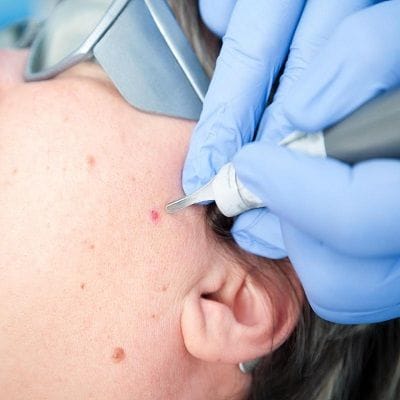 Which Method Is Best For Mole Removal