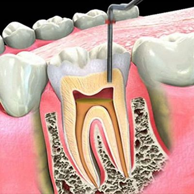 root canal treatment in dubai