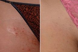 Before and After of Laser Hair Removal from Bikini Area