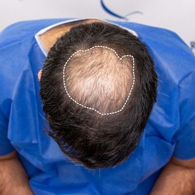 Can Crown Hair Transplant in Dubai be done?