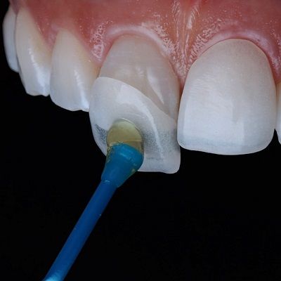 Can You Go Back to Normal Teeth After Dental Veneers?