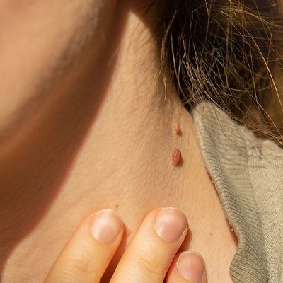 Can You Safely Remove Skin Tags Yourself