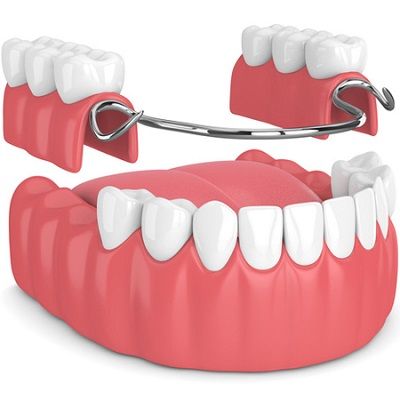 Dentures vs Implants: Which is Right for You?