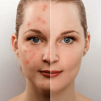 How To Get Rid Of Acne Scars Fast?