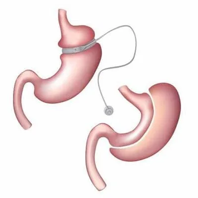 Metabolic Surgery Cost in Dubai