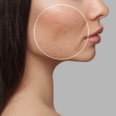 Microneedling and Acne Scars: Can It Help Reduce Their Appearance?