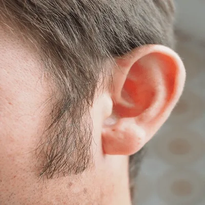 Sideburn Hair Transplant in Dubai