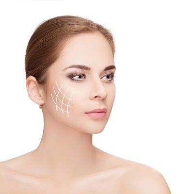 Thread lift Treatment in Dubai, Abu Dhabi & Sharjah