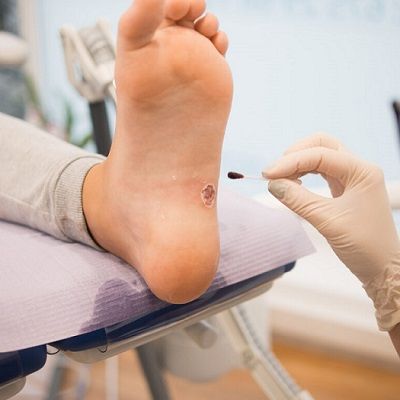 Warts Removal Surgery: Is it Worth the Pain and Expense?