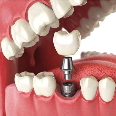 5 Reasons Why Dental Implants Are So Popular