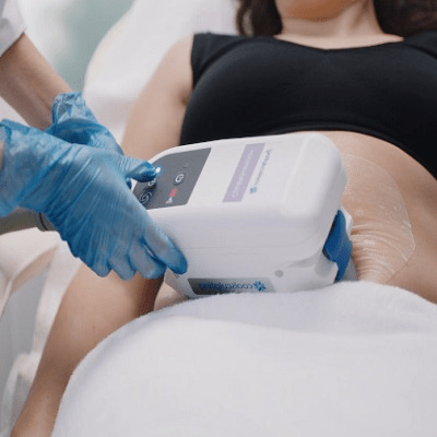Does CoolSculpting in Dubai Work on Belly Fat?