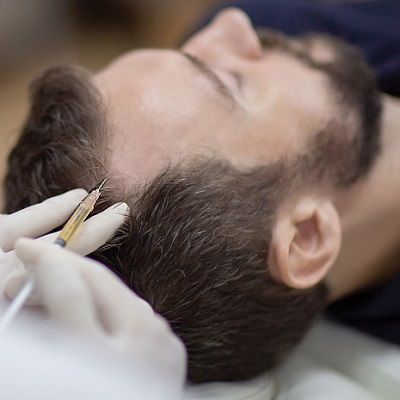 How Long Does PRP Last for Hair Loss and its Success Rate