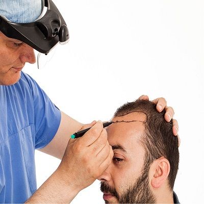 Say Hello to Thicker, Fuller Hair with Stem Cell Hair Transplant