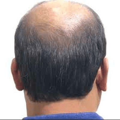 The Pros And Cons Of a Crown Hair Transplant in Dubai