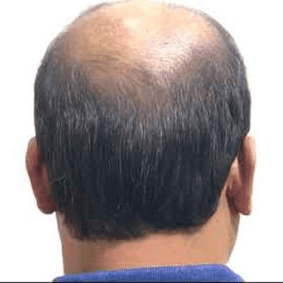 The Pros And Cons Of a Crown Hair Transplant