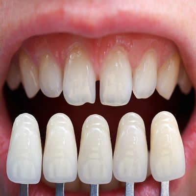 What is the Lifespan of Dental Veneers in Dubai?