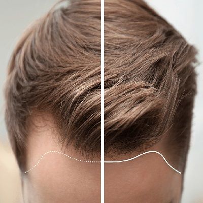 Can Hairline Be Re-grown Through Hair Transplantation?