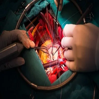 Gall Bladder Stone Treatment In Dubai