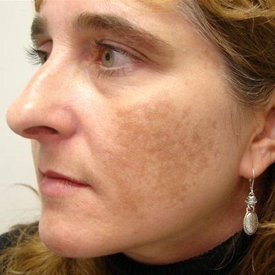 Melasma No More: Dubai’s Revolutionary Treatment Solutions