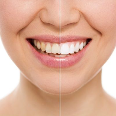 Teeth Whitening is a Costly Treatment