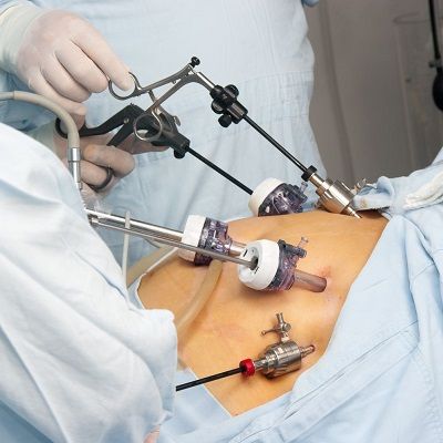 What Requirements Are Needed for Weight Loss Surgery?