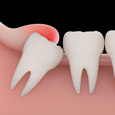 Wisdom Tooth Extraction Recovery