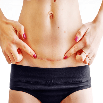 Are Tummy Tuck Results Permanent?