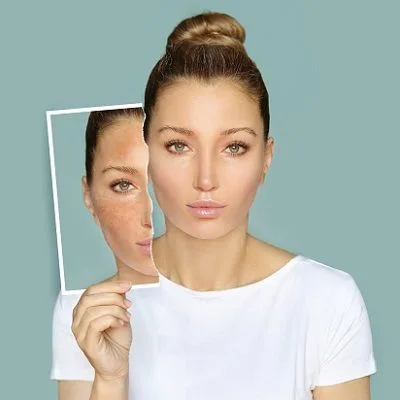 Cosmelan Peel for Sensitive Skin