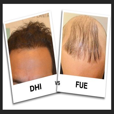 DHI vs FUE Hair Transplant