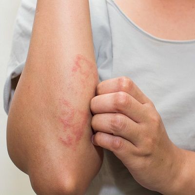 Eczema Treatment in Dubai