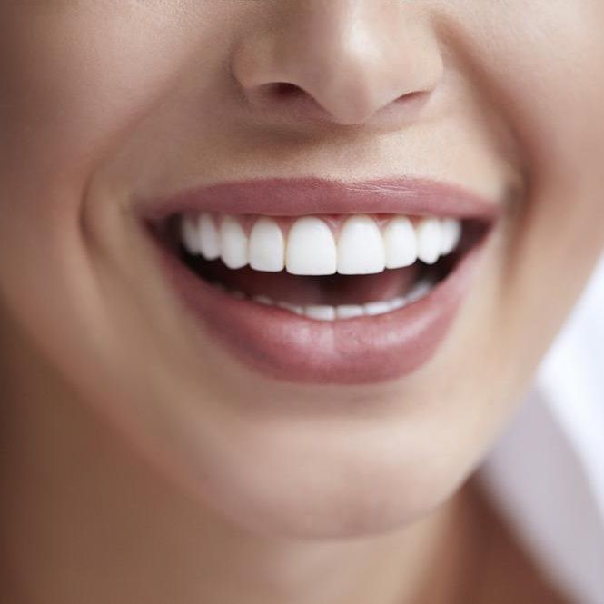 Is it Possible to Revert Back to Normal Teeth After Dental Veneers?