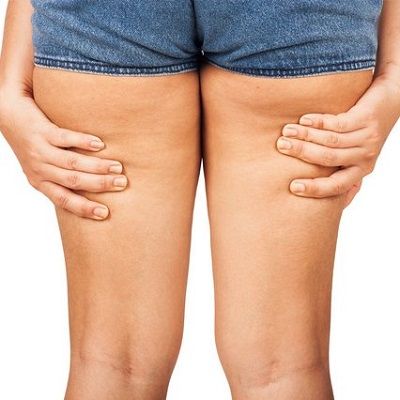 Thigh Lift After Weight Loss in Dubai