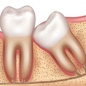 Wisdom Teeth – Infection & Extraction