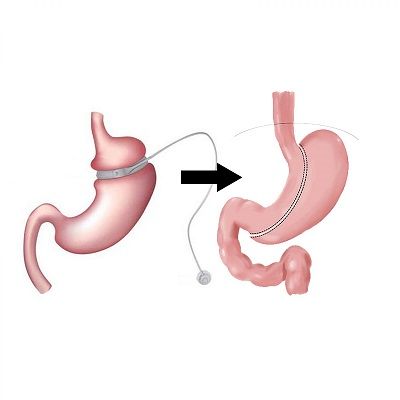 Is Bariatric Revision Surgery Right for You?
