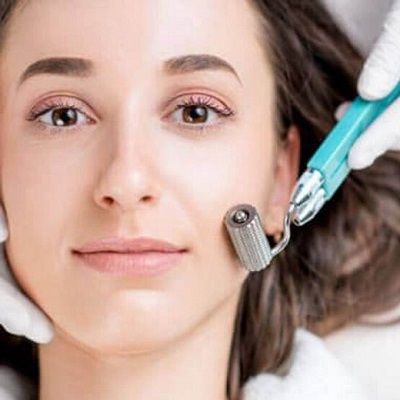 Microneedling for Skin Pigmentation A Promising Treatment Option