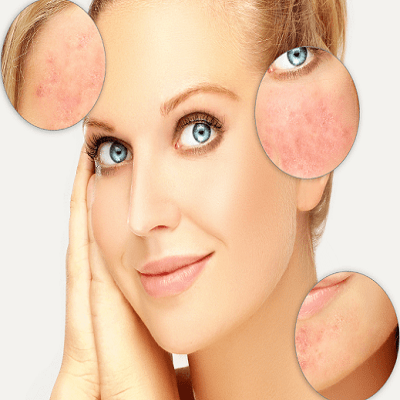 Reduce Facial Redness with Rosacea Treatment